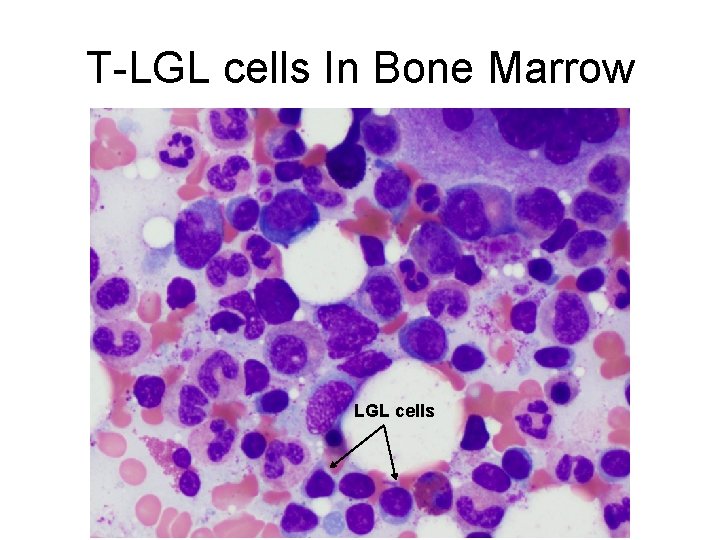 T-LGL cells In Bone Marrow LGL cells 