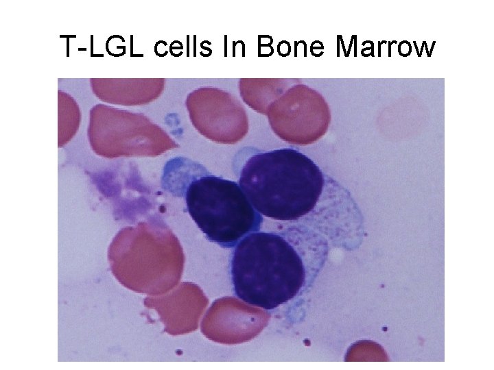 T-LGL cells In Bone Marrow 