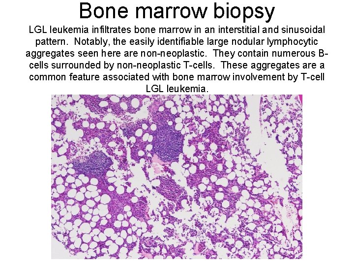 Bone marrow biopsy LGL leukemia infiltrates bone marrow in an interstitial and sinusoidal pattern.