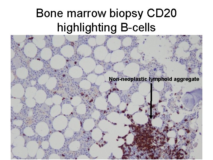 Bone marrow biopsy CD 20 highlighting B-cells Non-neoplastic lymphoid aggregate 