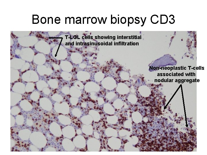 Bone marrow biopsy CD 3 T-LGL cells showing interstitial and intrasinusoidal infiltration Non-neoplastic T-cells