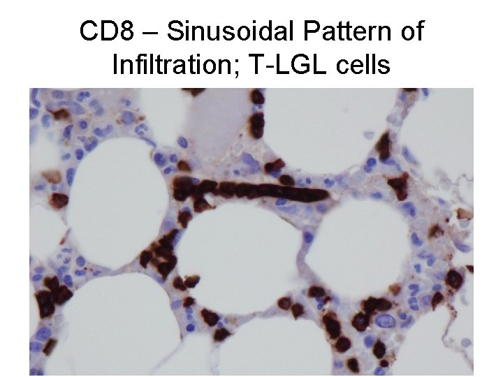 CD 8 – Sinusoidal Pattern of Infiltration; T-LGL cells 