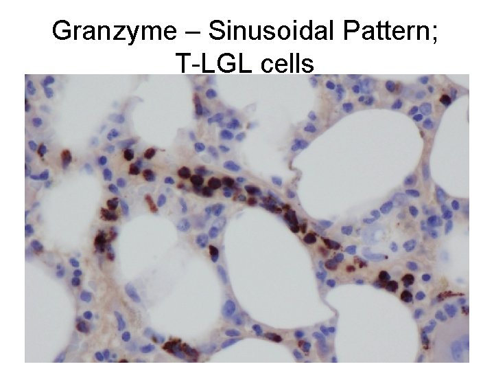 Granzyme – Sinusoidal Pattern; T-LGL cells 