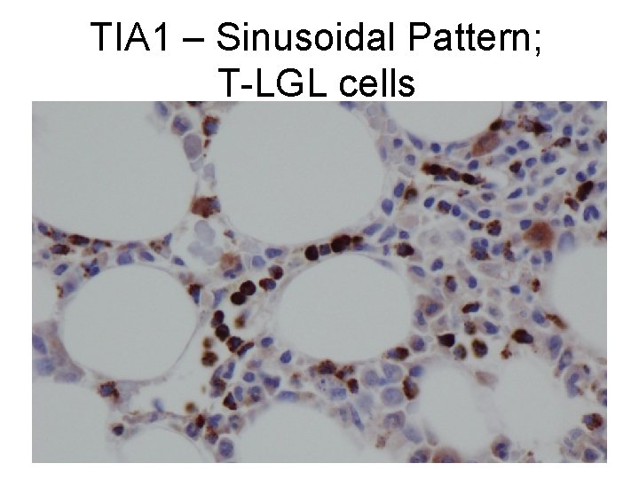 TIA 1 – Sinusoidal Pattern; T-LGL cells 