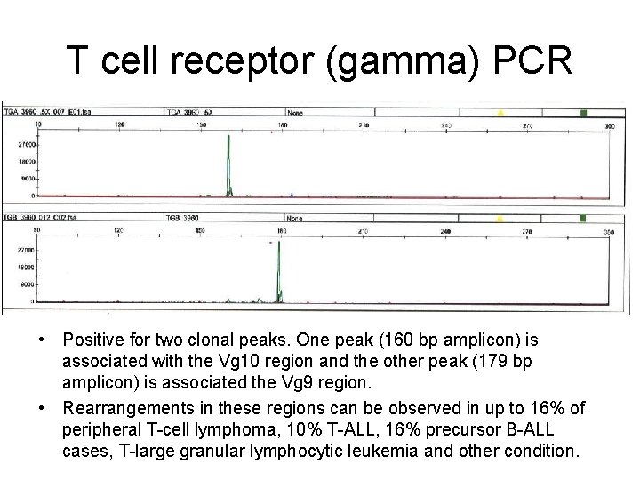 T cell receptor (gamma) PCR • Positive for two clonal peaks. One peak (160