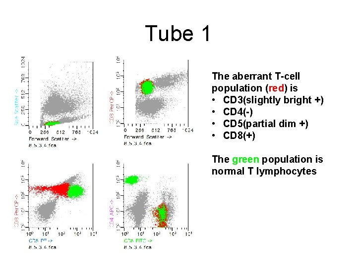 Tube 1 The aberrant T-cell population (red) is • CD 3(slightly bright +) •