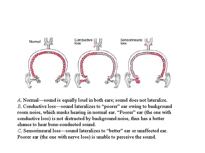 A, Normal—sound is equally loud in both ears; sound does not lateralize. B, Conductive
