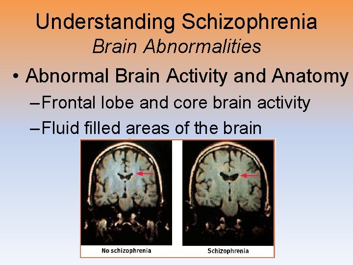 Understanding Schizophrenia Brain Abnormalities • Abnormal Brain Activity and Anatomy – Frontal lobe and