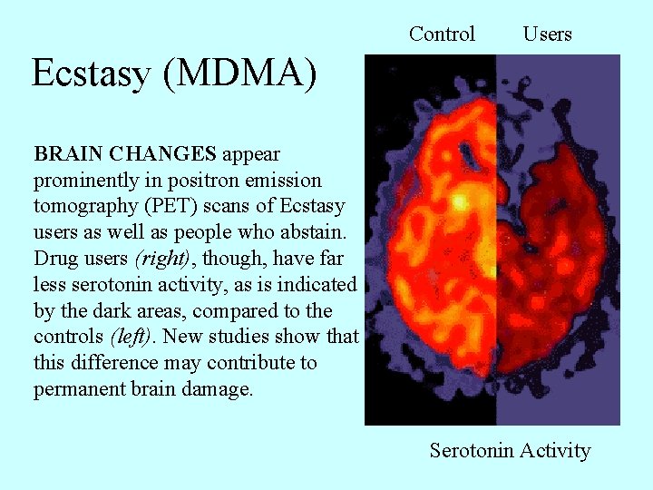 Control Users Ecstasy (MDMA) BRAIN CHANGES appear prominently in positron emission tomography (PET) scans