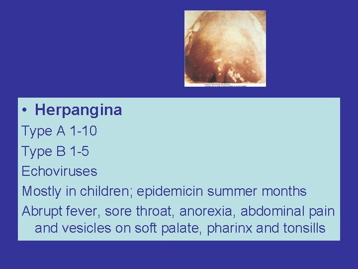  • Herpangina Type A 1 -10 Type B 1 -5 Echoviruses Mostly in