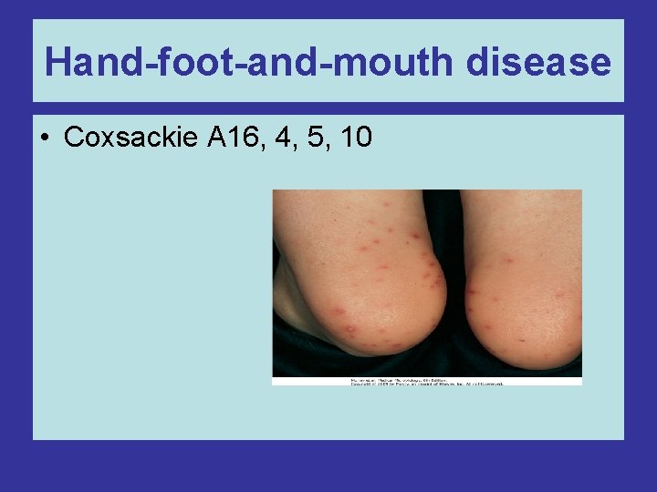 Hand-foot-and-mouth disease • Coxsackie A 16, 4, 5, 10 