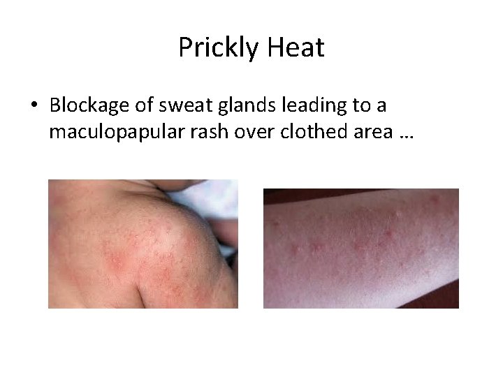 Prickly Heat • Blockage of sweat glands leading to a maculopapular rash over clothed