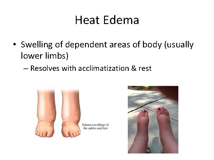 Heat Edema • Swelling of dependent areas of body (usually lower limbs) – Resolves