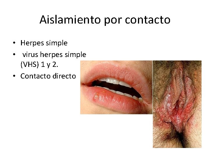 Aislamiento por contacto • Herpes simple • virus herpes simple (VHS) 1 y 2. Aislamiento por contacto • Herpes simple • virus herpes simple (VHS) 1 y 2.