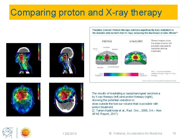Comparing proton and X-ray therapy The results of irradiating a nasopharyngeal carcinoma by X-ray