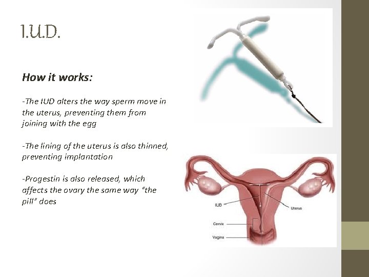 I. U. D. How it works: -The IUD alters the way sperm move in I. U. D. How it works: -The IUD alters the way sperm move in