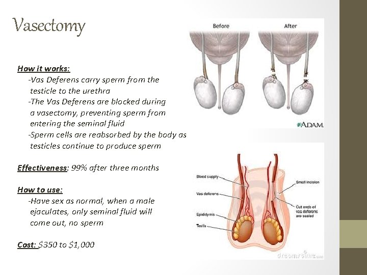 Vasectomy How it works: -Vas Deferens carry sperm from the testicle to the urethra Vasectomy How it works: -Vas Deferens carry sperm from the testicle to the urethra