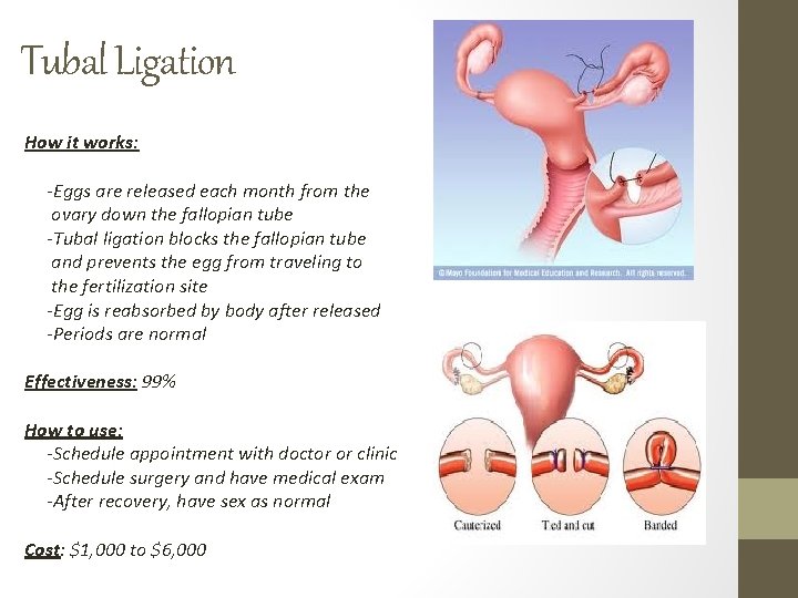 Tubal Ligation How it works: -Eggs are released each month from the ovary down Tubal Ligation How it works: -Eggs are released each month from the ovary down