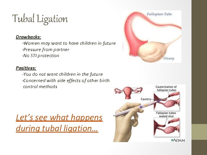 Tubal Ligation Drawbacks: -Women may want to have children in future -Pressure from partner Tubal Ligation Drawbacks: -Women may want to have children in future -Pressure from partner