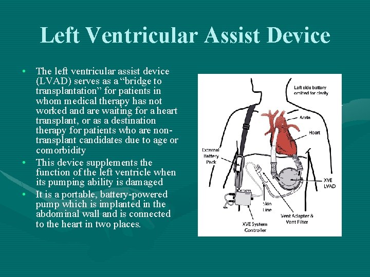 Left Ventricular Assist Device • The left ventricular assist device (LVAD) serves as a