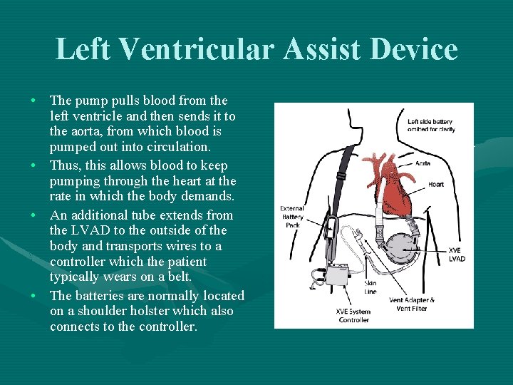 Left Ventricular Assist Device • The pump pulls blood from the left ventricle and