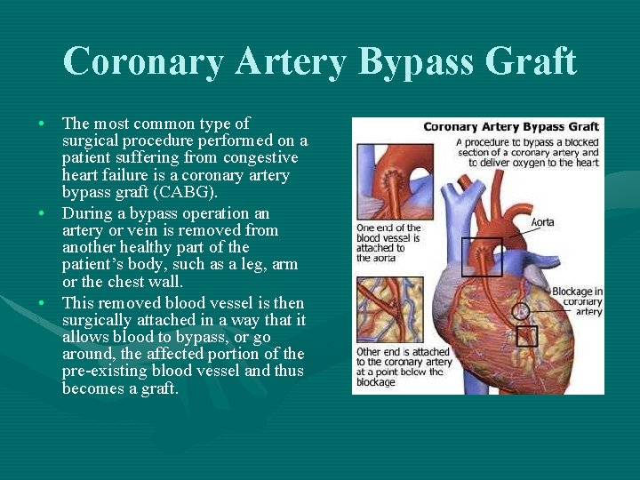 Coronary Artery Bypass Graft • The most common type of surgical procedure performed on