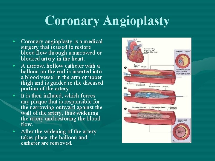 Coronary Angioplasty • Coronary angioplasty is a medical surgery that is used to restore