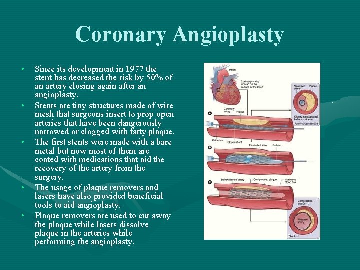 Coronary Angioplasty • • • Since its development in 1977 the stent has decreased