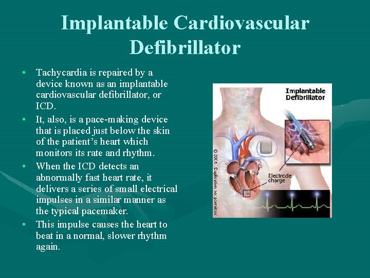 Implantable Cardiovascular Defibrillator • Tachycardia is repaired by a device known as an implantable