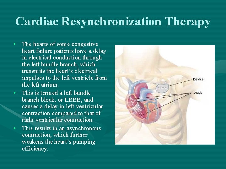 Cardiac Resynchronization Therapy • The hearts of some congestive heart failure patients have a