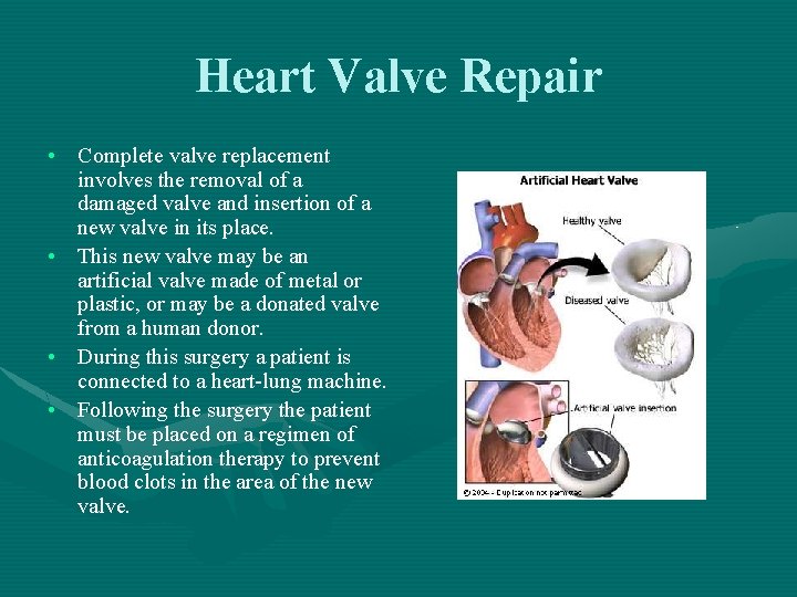 Heart Valve Repair • Complete valve replacement involves the removal of a damaged valve