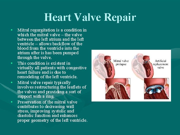 Heart Valve Repair • Mitral regurgitation is a condition in which the mitral valve