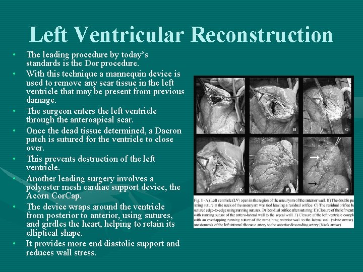 Left Ventricular Reconstruction • • The leading procedure by today’s standards is the Dor