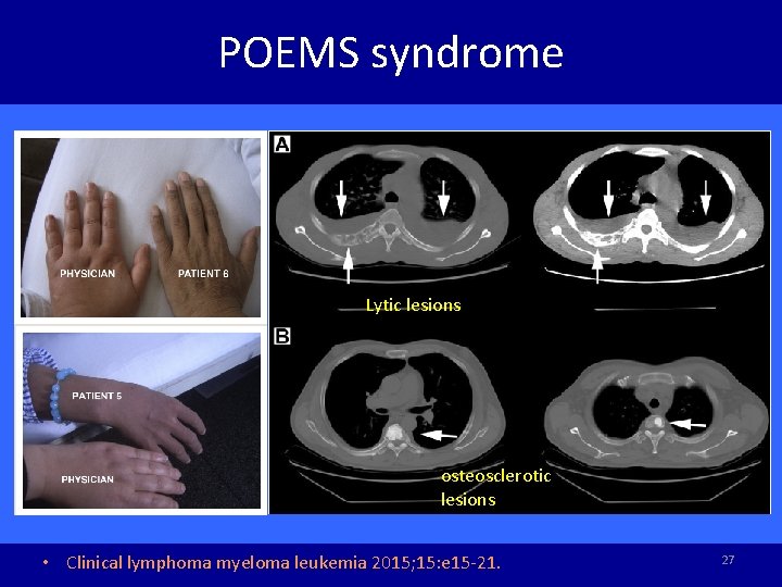 POEMS syndrome Lytic lesions osteosclerotic lesions • Clinical lymphoma myeloma leukemia 2015; 15: e