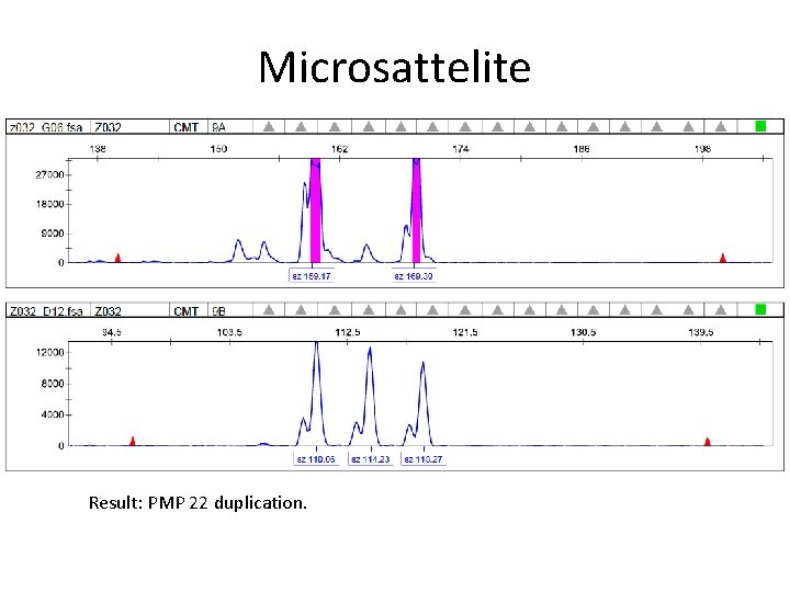 Microsattelite Result: PMP 22 duplication. 