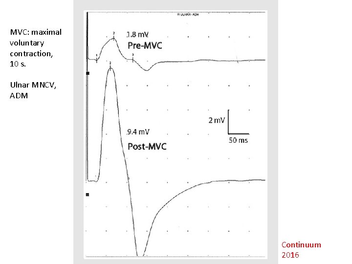 MVC: maximal voluntary contraction, 10 s. Ulnar MNCV, ADM Continuum 2016 