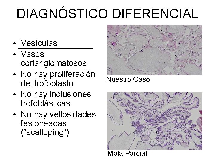 DIAGNÓSTICO DIFERENCIAL • Vesículas • Vasos coriangiomatosos • No hay proliferación del trofoblasto •