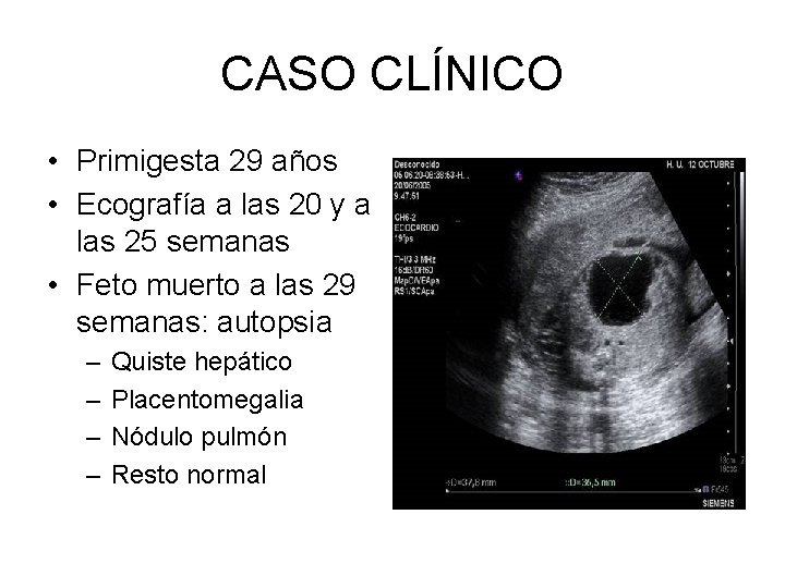 CASO CLÍNICO • Primigesta 29 años • Ecografía a las 20 y a las
