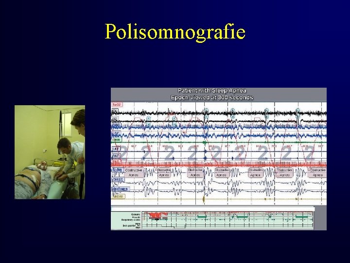 Polisomnografie 