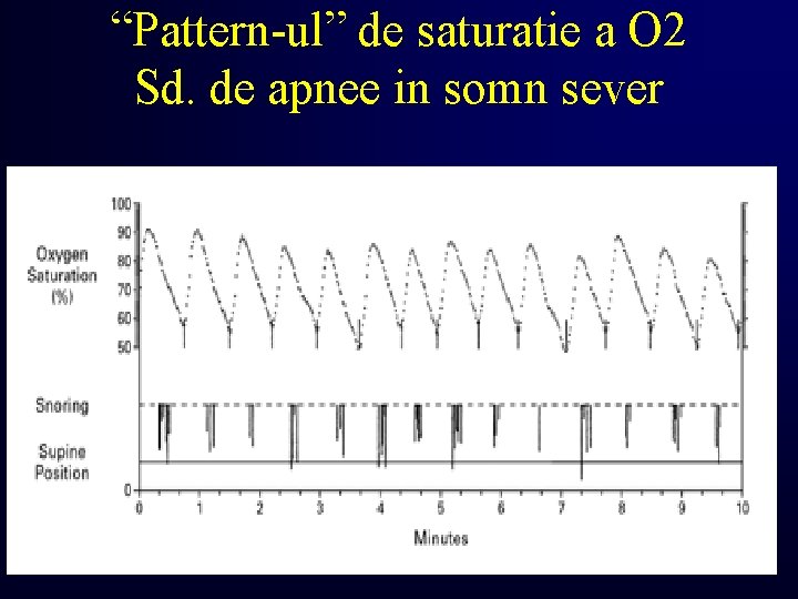 “Pattern-ul” de saturatie a O 2 Sd. de apnee in somn sever 