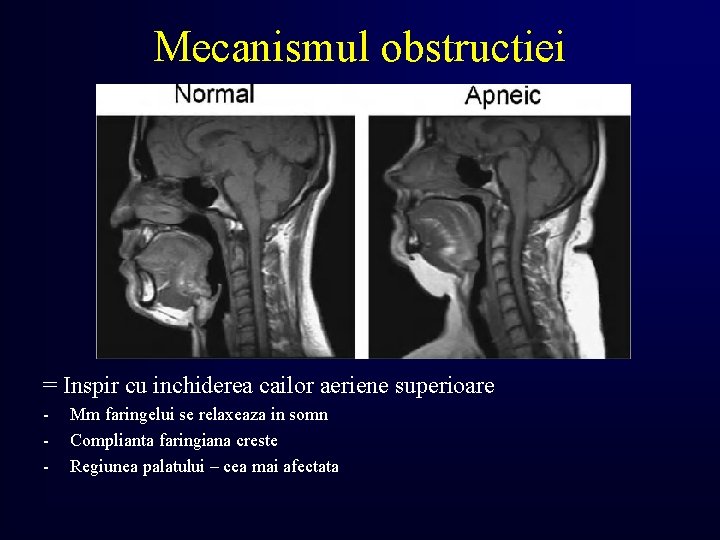 Mecanismul obstructiei = Inspir cu inchiderea cailor aeriene superioare - Mm faringelui se relaxeaza