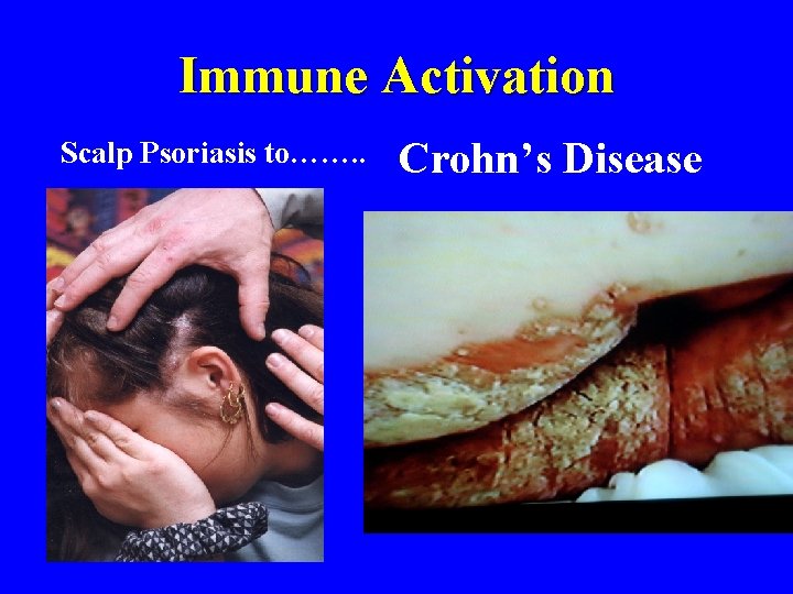 Immune Activation Scalp Psoriasis to……. . Crohn’s Disease 