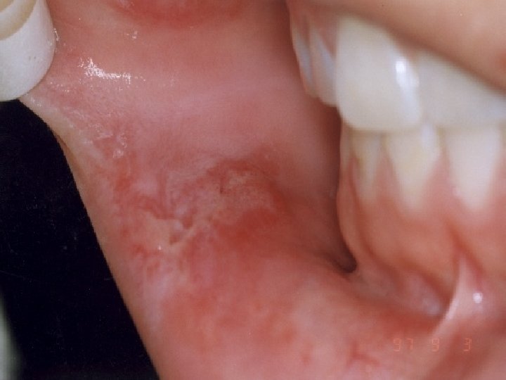 Canker Sore 