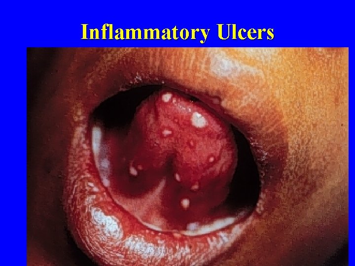 Inflammatory Ulcers 