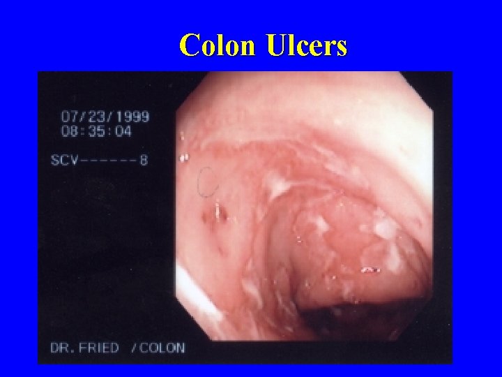 Colon Ulcers 