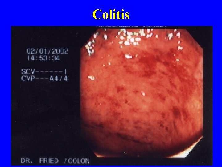 Colitis 