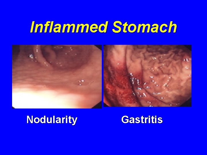 Inflammed Stomach Nodularity Gastritis 