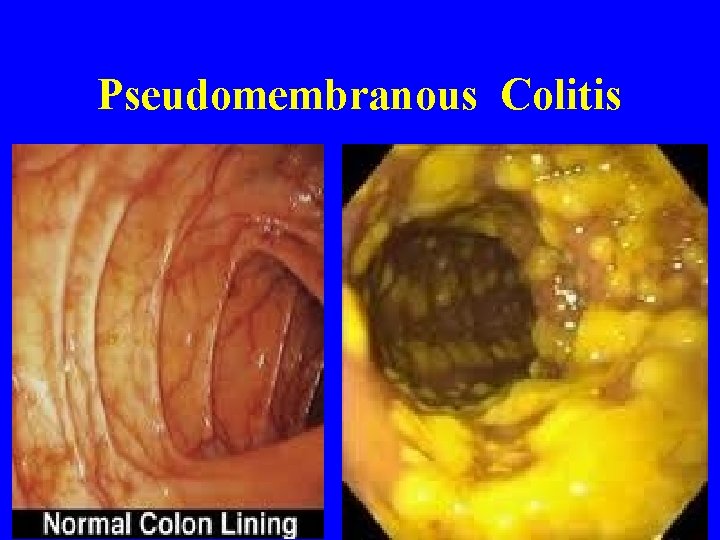 Pseudomembranous Colitis 