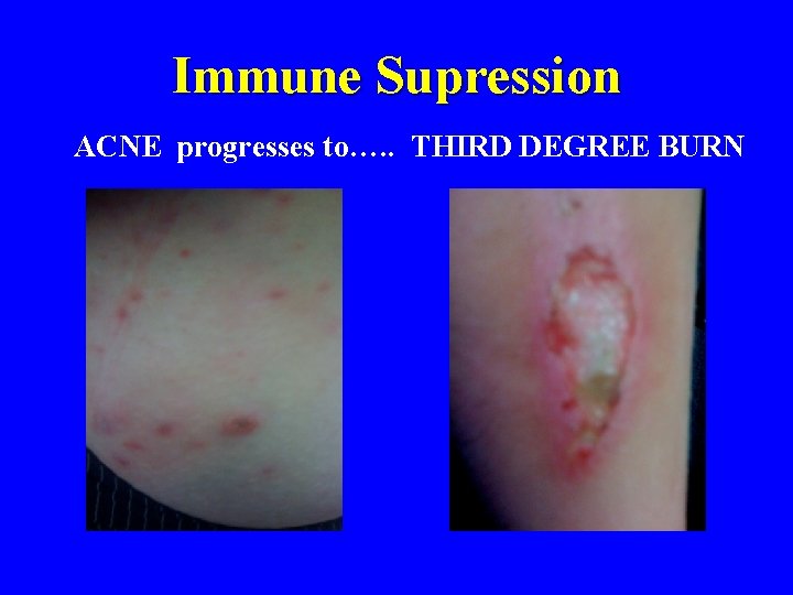 Immune Supression ACNE progresses to…. . THIRD DEGREE BURN 