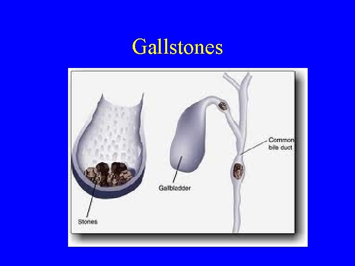 Gallstones 